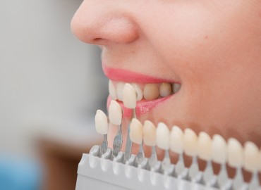 Estética Dental y Diseño de Sonrisa: Carillas y Aclaramiento Dental