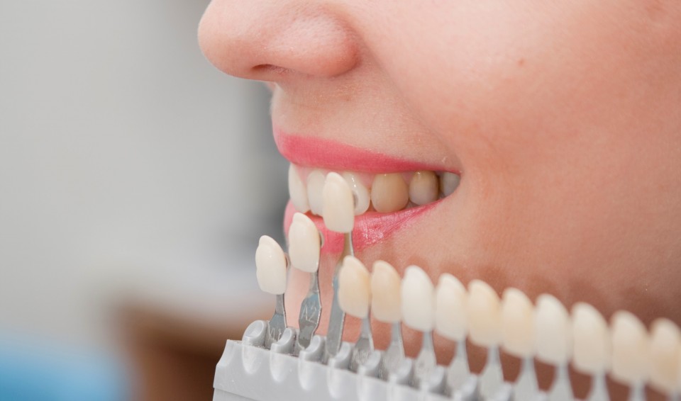 Estética Dental y Diseño de Sonrisa: Carillas y Aclaramiento Dental