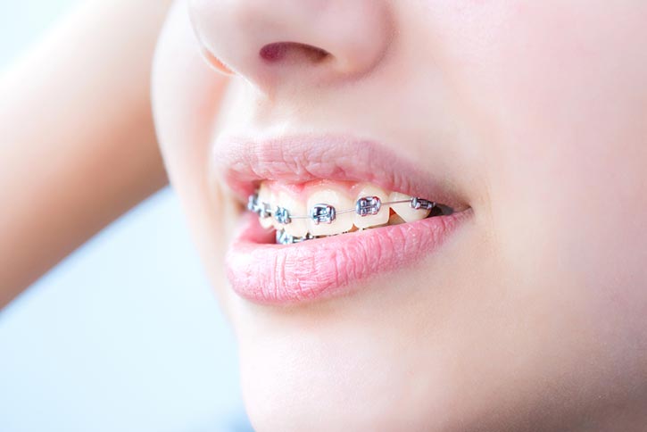 COMER CON BRACKETS