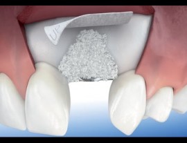 Regeneración ósea vertical