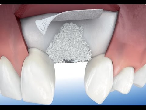 Regeneración ósea vertical