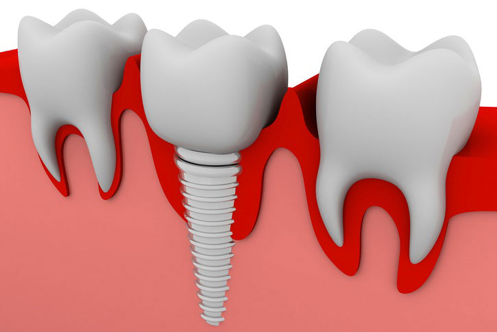 Implantes dentales: compañeros de largo recorrido